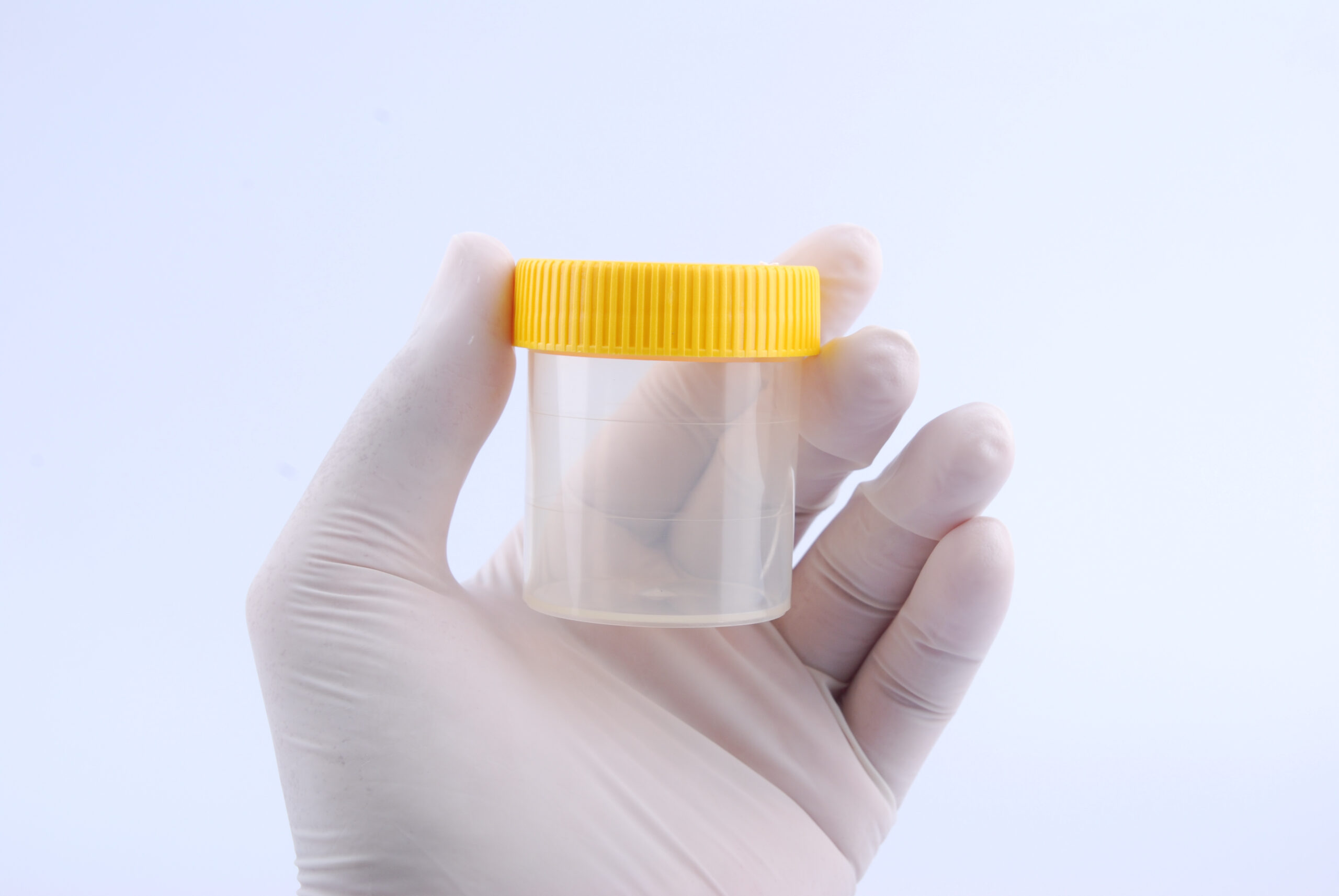 A gloved hand holding a drug test urine sample container